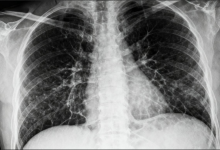 Asbestos Lung Cancer Compensation
