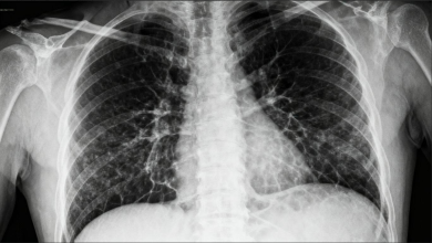 Asbestos Lung Cancer Compensation Asbestos Lung Cancer Compensation